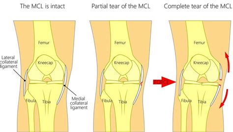 MCL Sprain: Symptoms, Grades & Treatment Plan