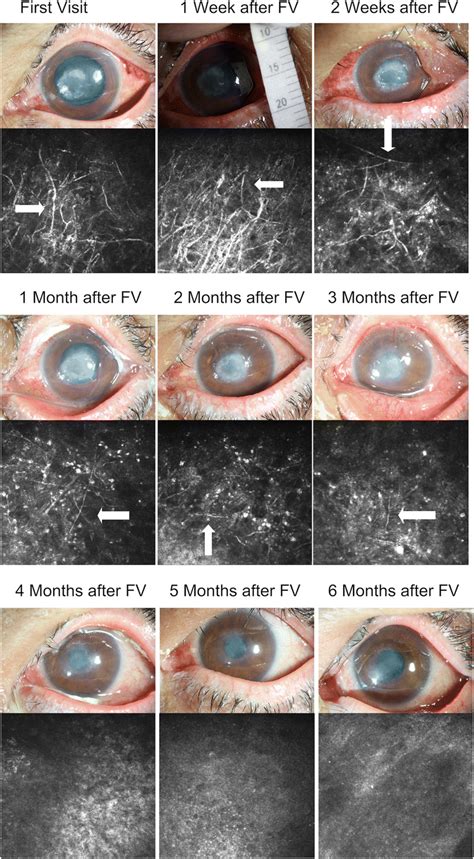 Corneal Ulcer