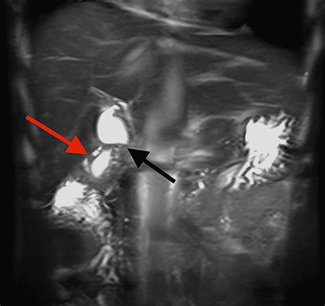 Cureus | Gallbladder Adenomyomatosis Presenting With Abdominal Pain