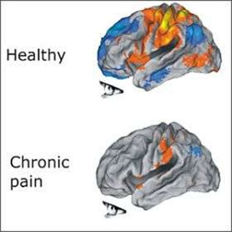 Chronic Pain Harms the Brain