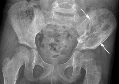 RiT radiology: Pelvic Ewing's Sarcoma