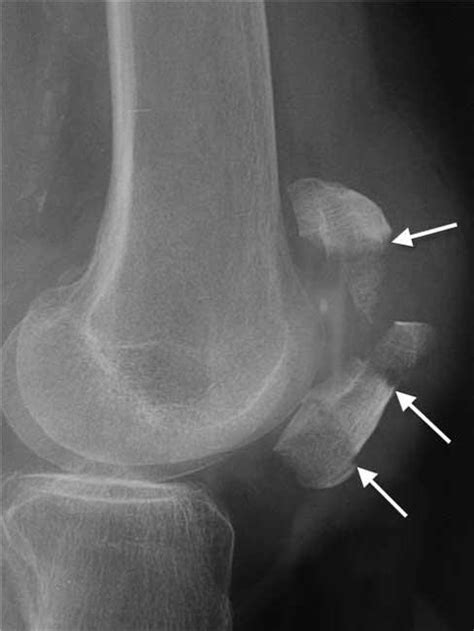 Patellar Fractures (Broken Kneecap) - OrthoInfo - AAOS