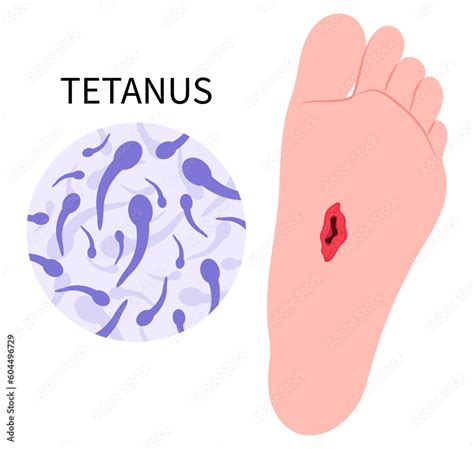 Tetanus infection bacteria Clostridium tetani virus bacterial toxin lockjaw Vaccination and ...