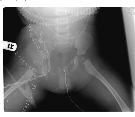 Hemipelvectomy after severe pelvic injury in Factor VII deficiency ...