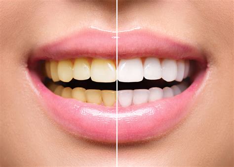 Teeth Whitening After Braces - Belmar Orthodontics