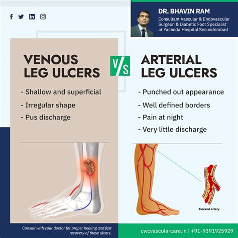 Venous Stasis Ulcer Treatment Pictures Causes Symptoms