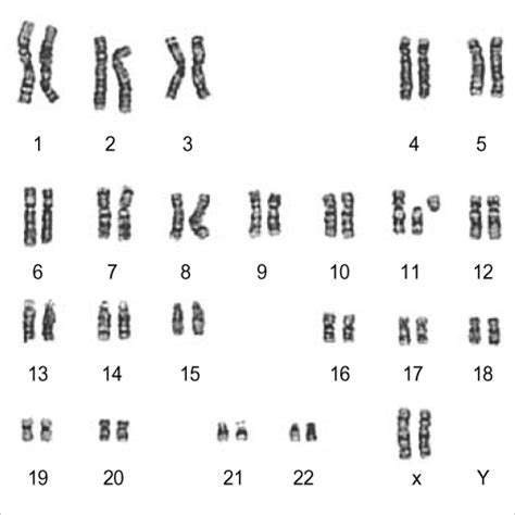 Figure 1:A De Novo Centric Fission of Chromosome 11 in a Patient with ...