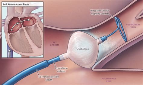 Global Atrial Fibrillation Surgery Market 2018-2021 Forecasts and ...