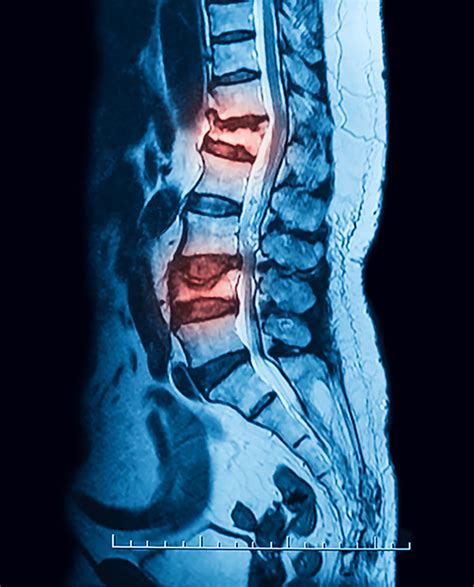 Compression Fracture Lumbar