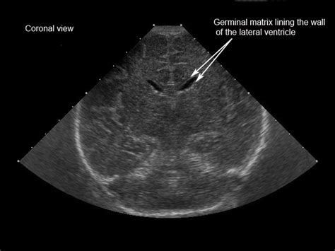 Germinal Matrix Brain Anatomy