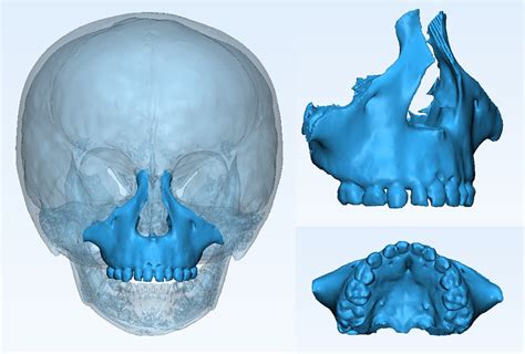 Racial disparity of Crouzon syndrome in maxilla and mandible ...