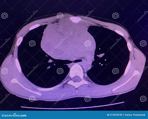 CT Scan Mass at Interior Mediastinum Stock Image - Image of care, hospital: 213470749