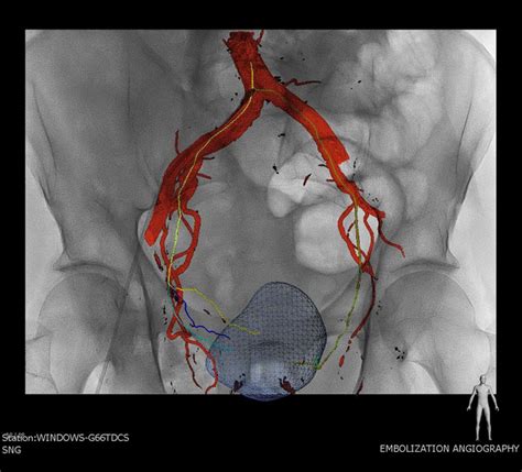 Men’s Health Virginia Beach | Prostate Artery Embolization (PAE) Portsmouth VA