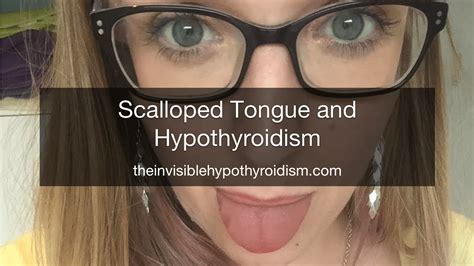 Scalloped Tongue and Hypothyroidism