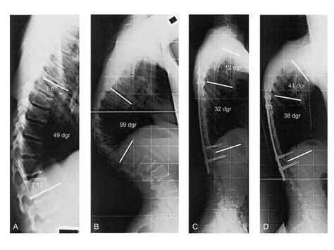 Scheuermann’s Disease - SpinePlus