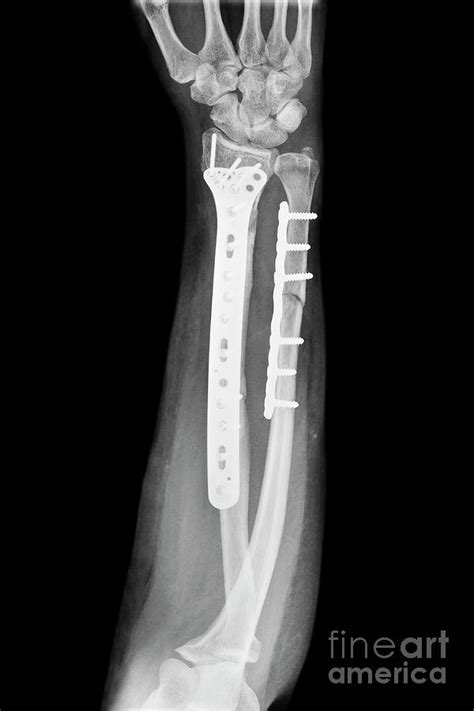 Pinned Fractured Lower Arm Bones Photograph by Science Photo Library