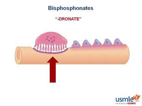 USMLE-Rx Express Video of the Week: Bisphosphonates - YouTube