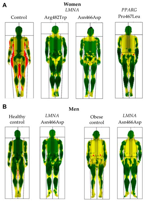 Cells | Free Full-Text | Clinical Spectrum of LMNA-Associated Type 2 Familial Partial ...