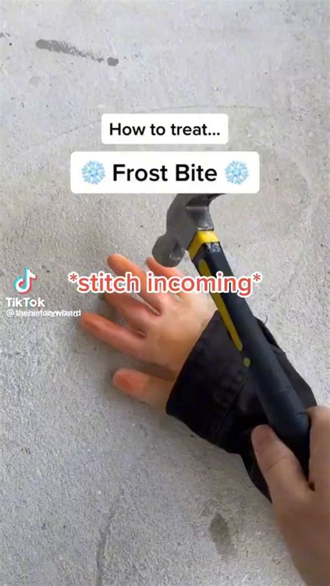 How to treat... Frost Bite - iFunny