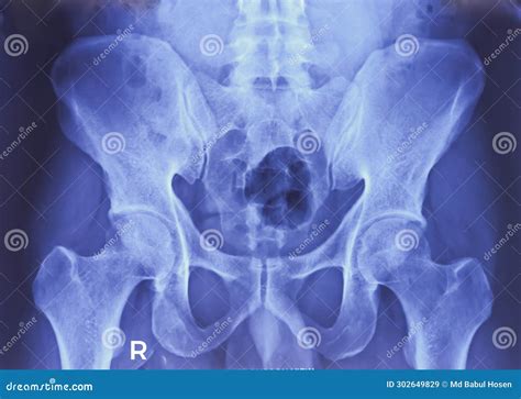 SI Joint X-ray. Mild Sclerosis at Articular Margin. Early Sacroiliitis Editorial Stock Image ...