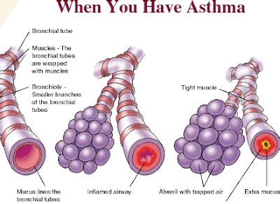 Bronchial Asthma Symptoms, Causes, Treatment and Natural Remedies