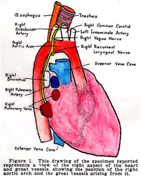 Image of right aortic arch