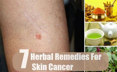 7 Amazing Herbal Remedies For Skin Cancer ~ Mzizi Mkavu