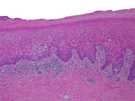 Early Hairy Leukoplakia