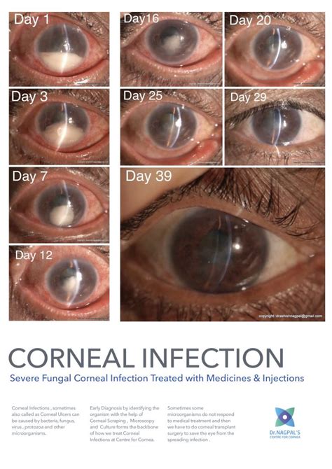 Corneal Infections - Corneal Ulcer - Dr Nagpal's Centre for Cornea