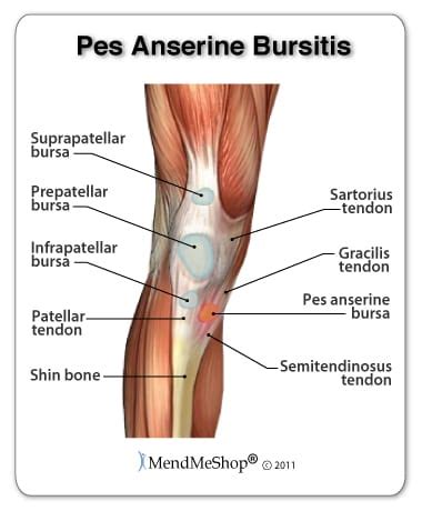 Pes Anserine Bursitis - Mississauga and Oakville Chiropractor and ...