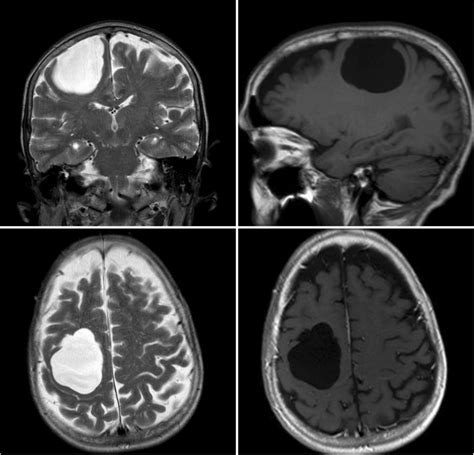 Upper left, axial T2 MRI shows a hyperintense cystic mass over right ...