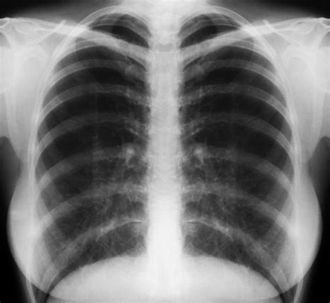 What Is a Tuberculosis Chest X-Ray? (with pictures)