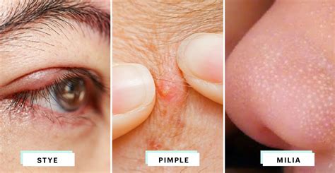 A Visual Guide to Identifying the Little Bump on Your Eyelid | Skin bumps, Pimple on eyelid ...