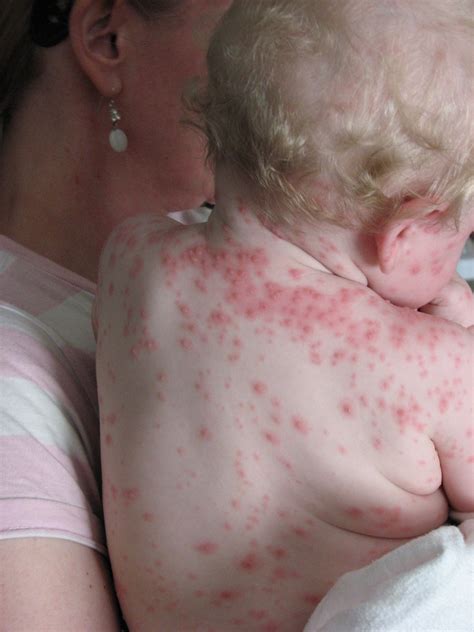 CHICKEN POX SYMPTOMS IN CHILDREN. SYMPTOMS IN CHILDREN - CHICKEN POX SYMPTOMS IN CHILDREN