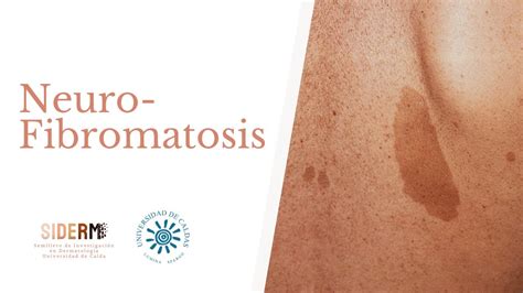 Neurofibromatosis Treatment