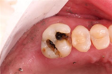 Managing fractured marginal ridge – Greater Curve