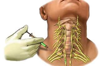 Peripheral Nerve Blocks - Compassioinate Pain Management