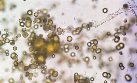 Microscopic image of Urinalysis. Abnormal urine exam. Uric acid ...