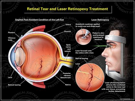 Laser Retinopexy Treatment for Retinal Tear