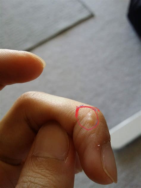 Blisters around my finger tips, any advice? : r/Dermatology