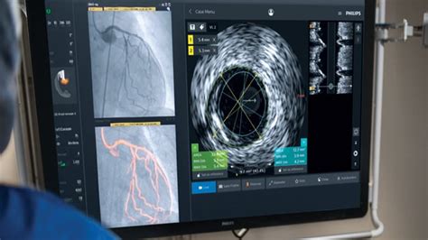 IVUS Image Interpretation - Coronary IVUS | Philips