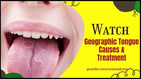 Geographic Tongue On Lips | Lipstutorial.org