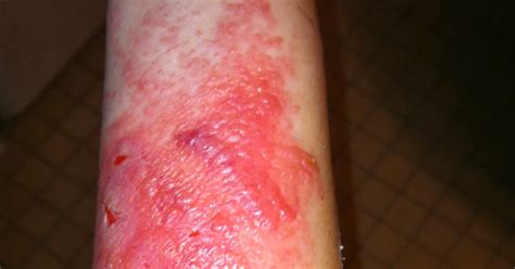 Kiddy Health: Poison ivy rash | Kiddy Health