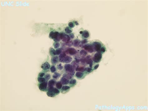 urothelial carcinoma cytology