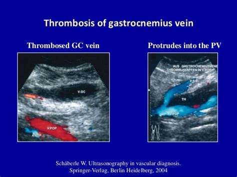 Doppler ultrasound in deep vein thrombosis