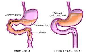 Gastro-intestinal Motility Disorder – SOFMEDICA.com