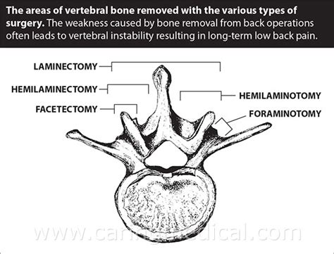 What Is A Hemilaminectomy - mapasgmaes