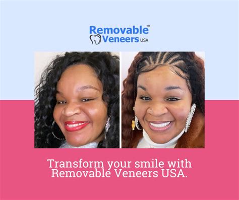 The Benefits of Choosing Clip-On Veneers for a Perfect Smile | Removable Veneers USA