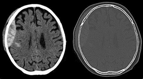 Traumatic Brain Injury (TBI): Epidural Hematoma (Extradural Haematoma)