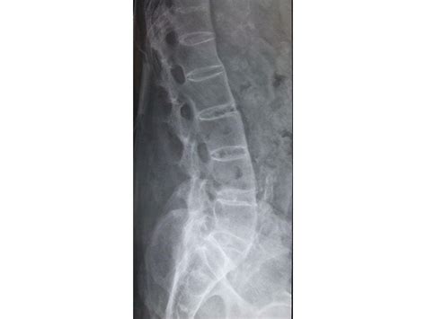 Ankylosing Spondylitis